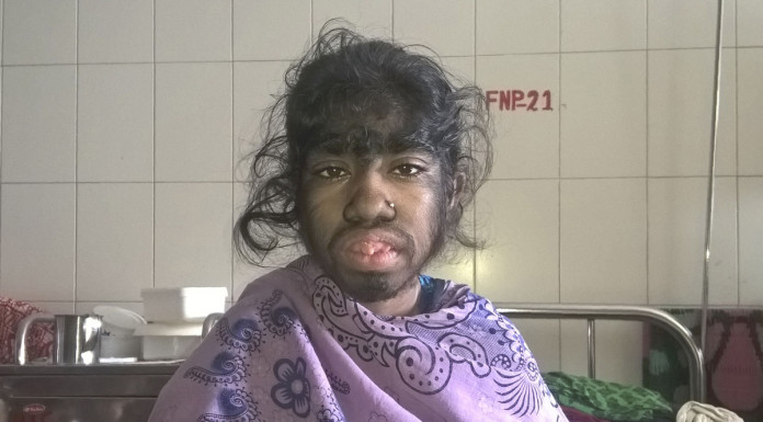 'Werewolf' Bangladeshi girl seeks help for rare excess hair condition