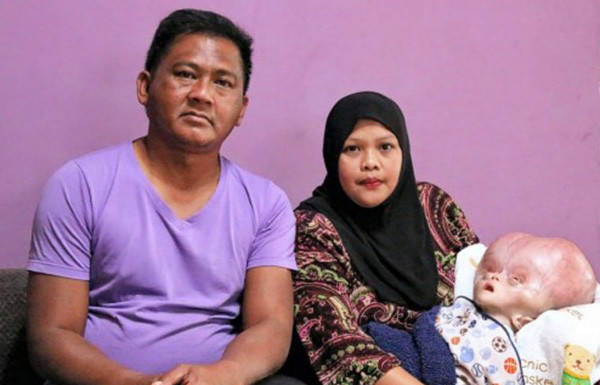 7-month-old Brunei boy with deformed skull dies