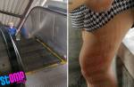 Escalator accidents - 15