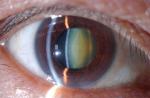 Dick Lee's struggles with vision problems - 4