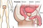 6 things to know about prostate cancer - 1