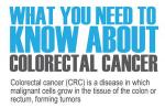 16 must-knows for colorectal cancer prevention - 0