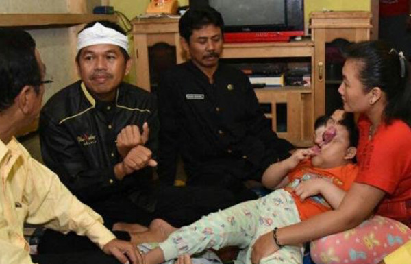 Help on the way for Indonesian girl born with with malformed face, incomplete skull
