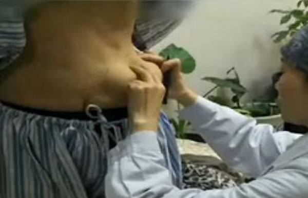 Boob job gone wrong: Woman’s breast fillers migrate to her belly